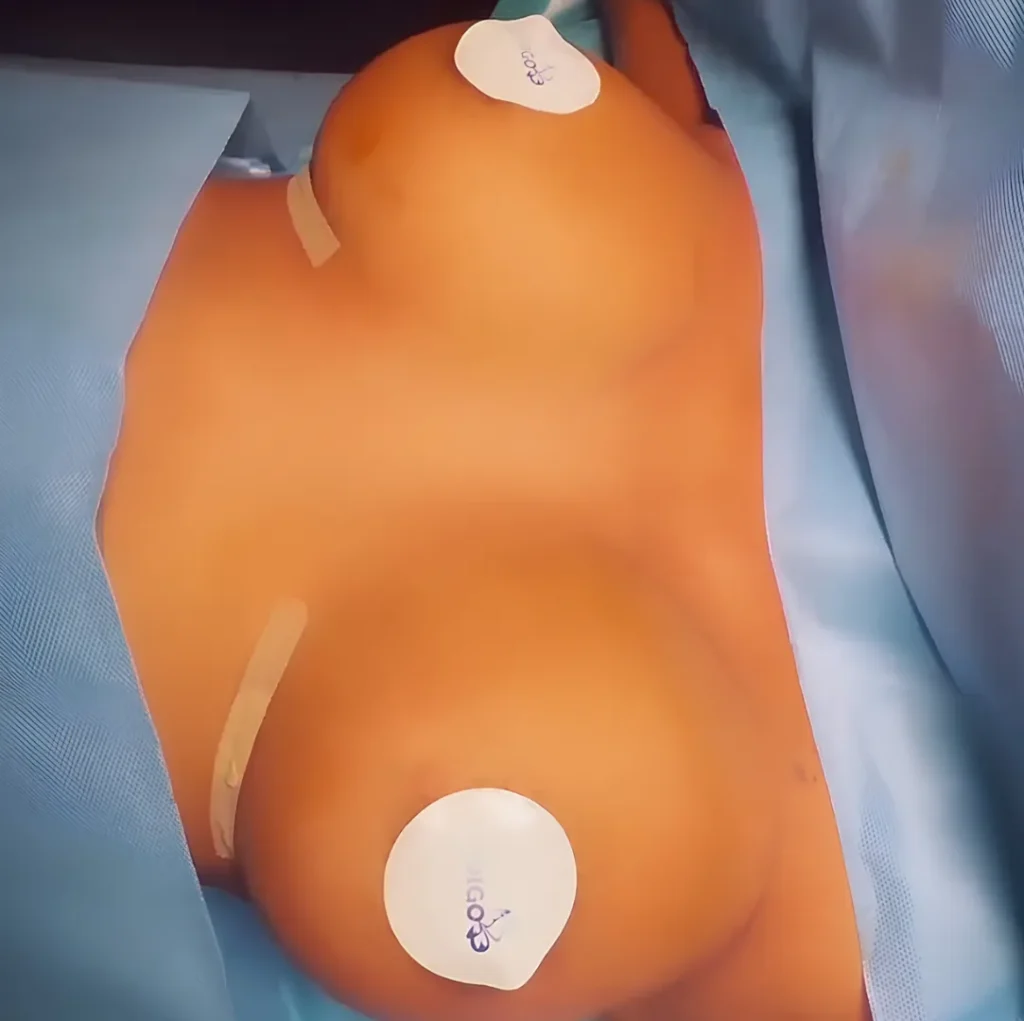 Breast Augmentation result