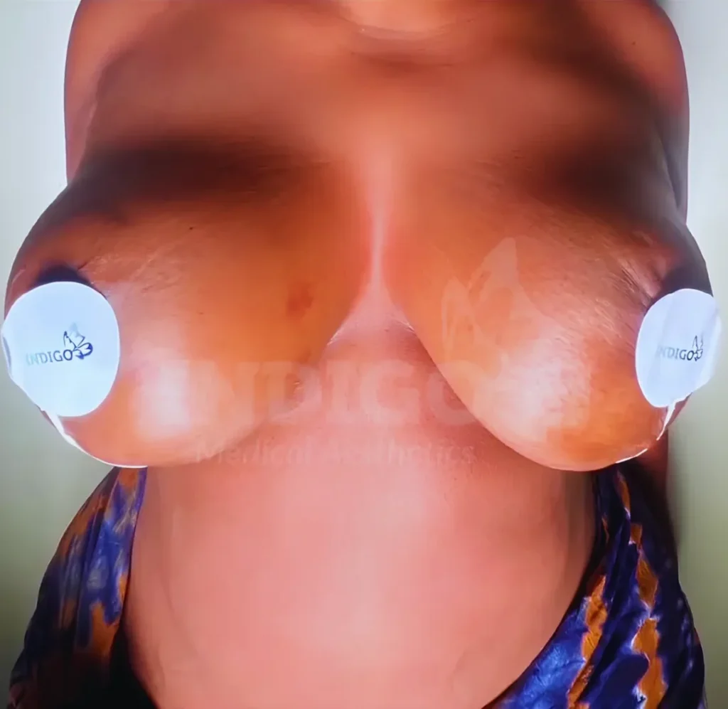 Breast Lift result