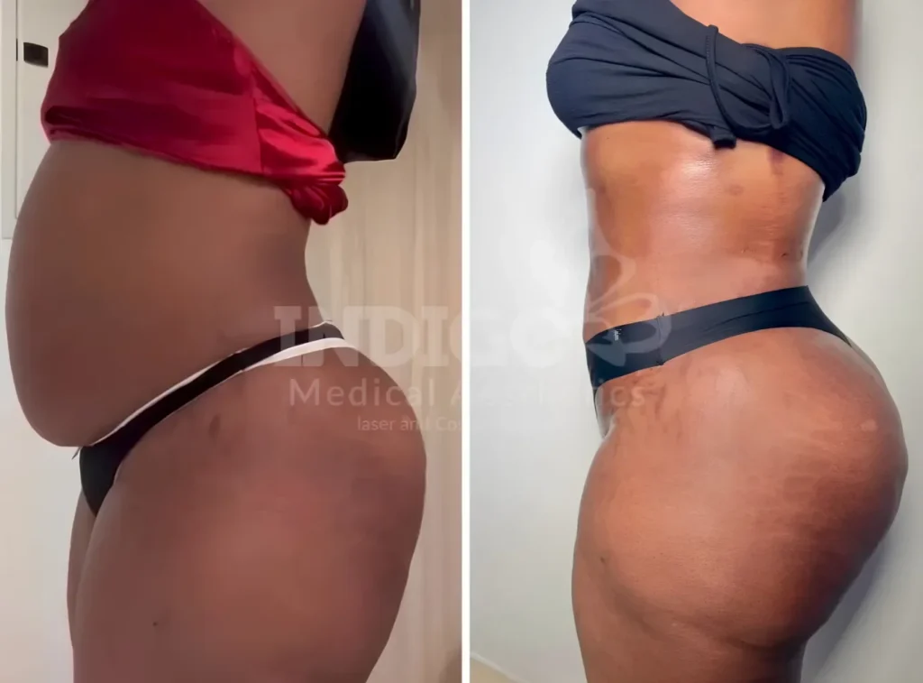 Liposuction · Before & After result