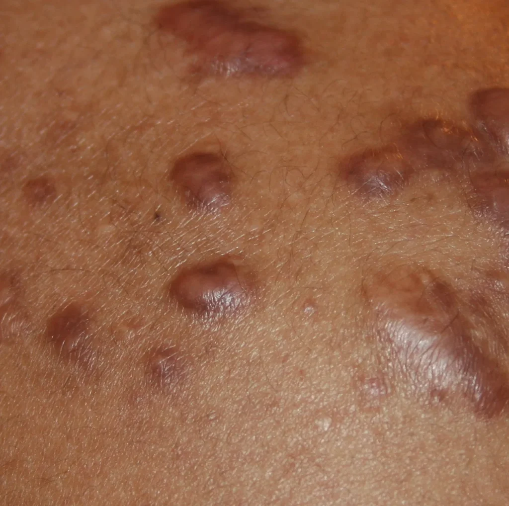 Keloid Scars result